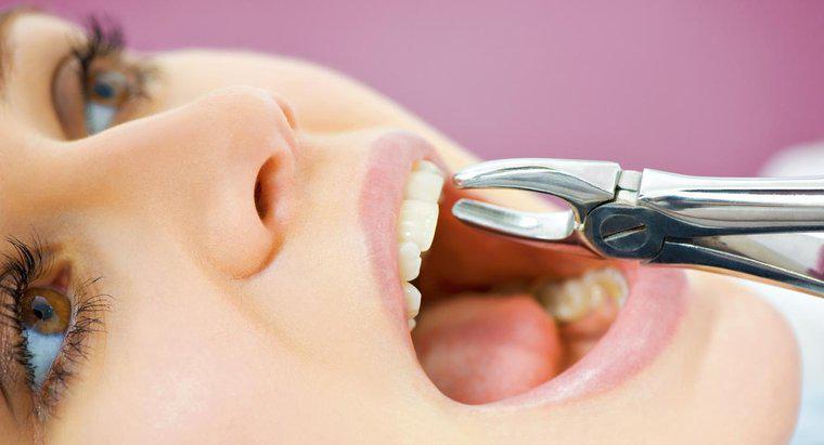 Mất bao lâu để một ổ răng lành sau khi nhổ răng?