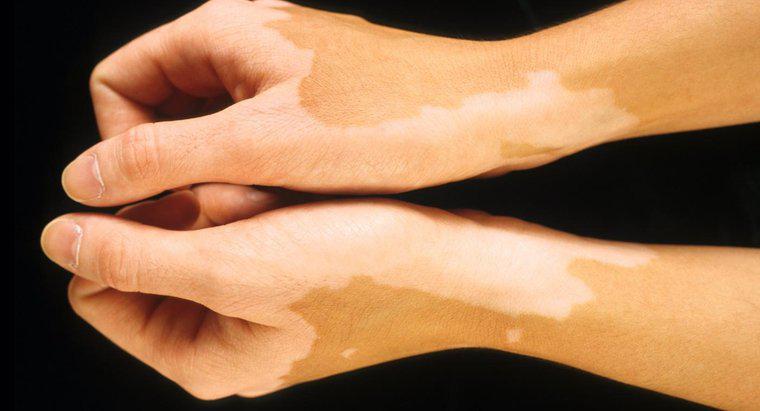 Nguyên nhân nào khiến các đốm sáng xuất hiện trên da?