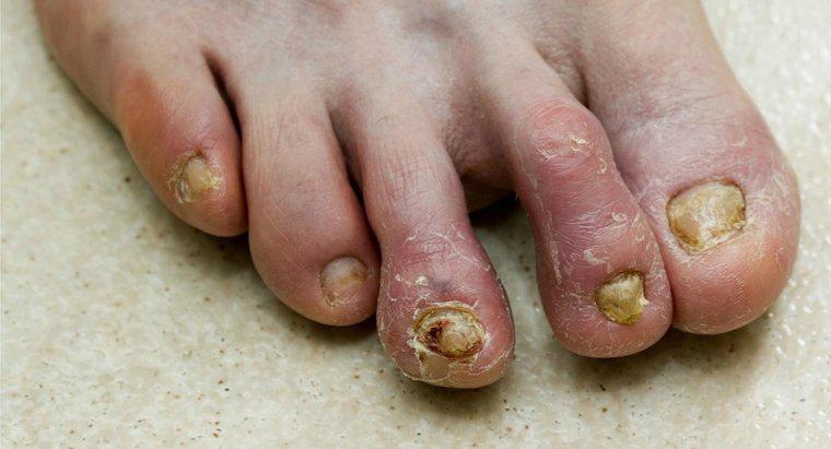 Các biện pháp khắc phục tại nhà đối với nấm móng chân là gì?