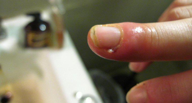 Người bị sưng ngón tay do nhiễm trùng lớp biểu bì cần phải làm gì?