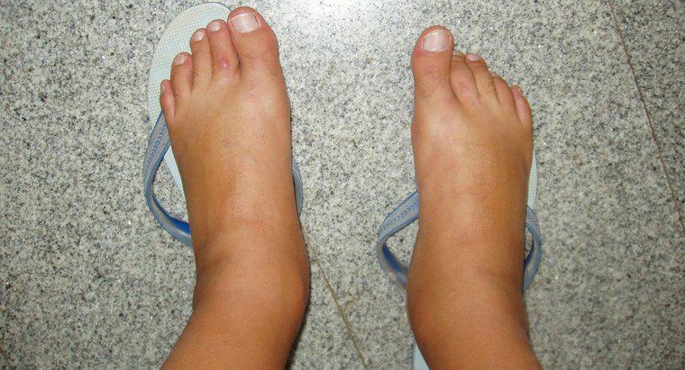 Nguyên nhân của sưng bàn chân là gì?