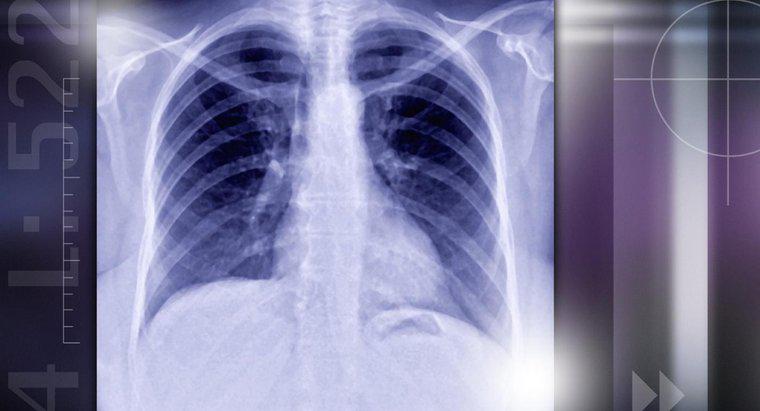 Nguyên nhân nào gây ra nốt sần ở phổi?