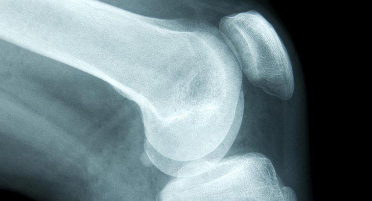 Các triệu chứng sớm nhất của bệnh ung thư xương là gì?