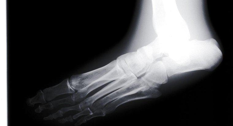 Làm thế nào bạn có thể sửa chữa bàn chân phẳng với điều trị?