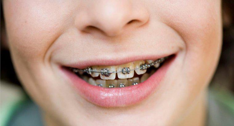 Làm thế nào để xỏ khuyên lưỡi ảnh hưởng đến niềng răng?