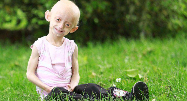 Một số thông tin thú vị về Progeria là gì?