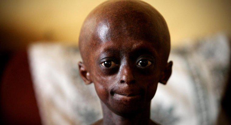 Những hạn chế nào một người bị Progeria có?