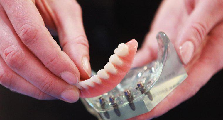 Răng giả gắn vào là gì?