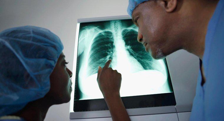 Những triệu chứng nào là duy nhất đối với bệnh ung thư phổi?