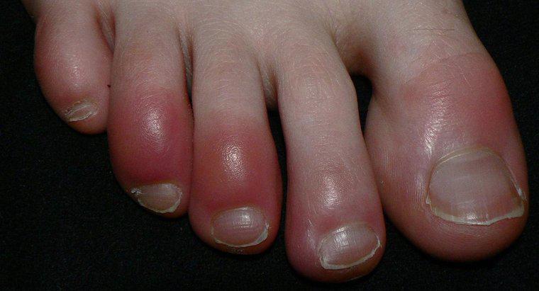 Ngón chân đỏ có phải là triệu chứng của hội chứng Raynaud không?