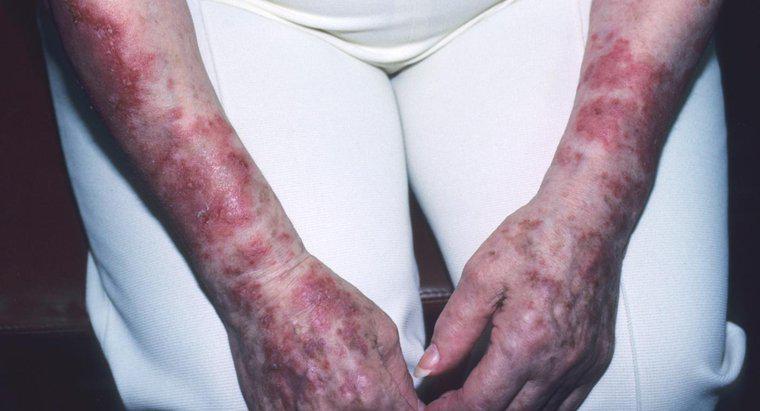 Lupus lây lan như thế nào?