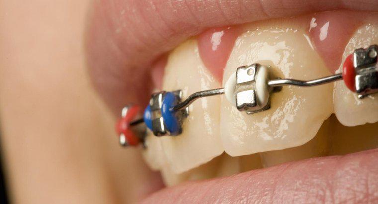 Mục đích của dây cao su trên niềng răng là gì?