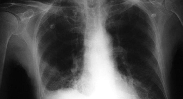 Viêm phổi phế quản là gì?