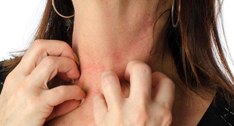 Một số nguyên nhân có thể gây ra phát ban xung quanh cổ và ngực là gì?