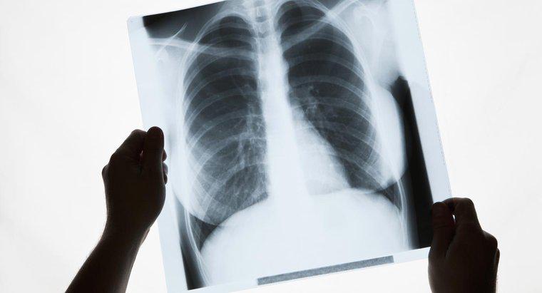 Nguyên nhân nào gây ra đốm trắng ở phổi?