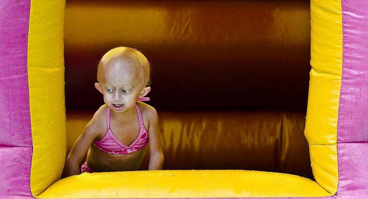 Bạn có thể sống được bao lâu với Progeria?