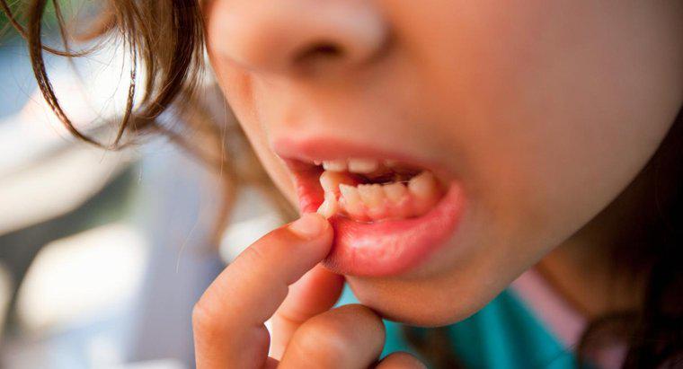 Nguyên nhân nào gây ra tình trạng răng thưa ở người lớn?
