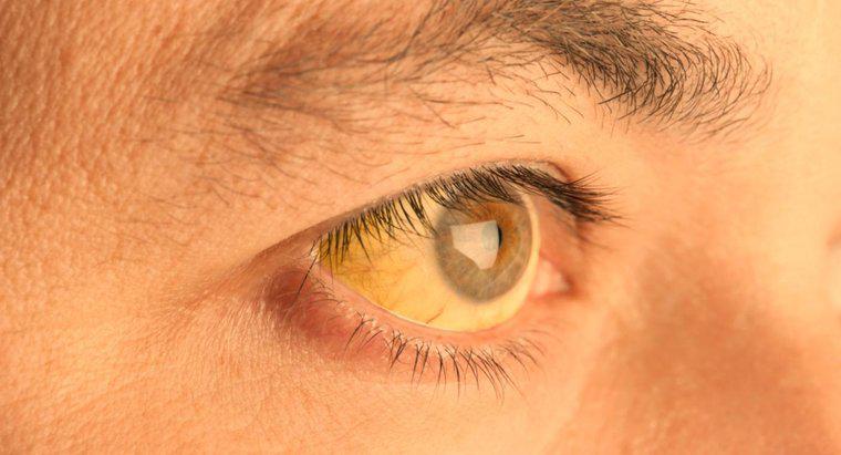 Nguyên nhân nào khiến da dưới mắt chuyển sang màu vàng?