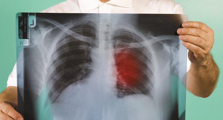 Dấu hiệu đầu tiên của bệnh ung thư phổi là gì?