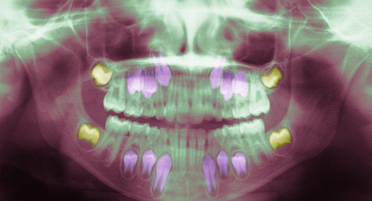 Nguyên nhân nào gây ra tình trạng nhiễm trùng răng khôn?